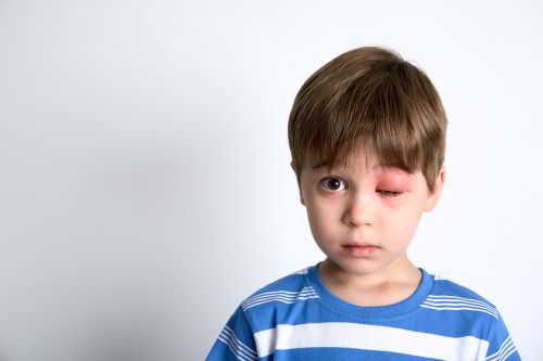 Children with acute allergic reactions spend unnecessary time in hospitals