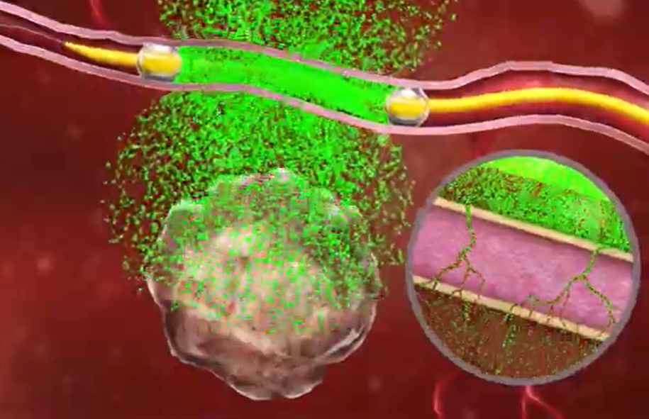 UVM Cancer Center first in Vermont to use new pancreatic cancer treatment